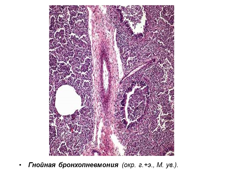 Гнойная бронхопневмония (окр. г.+э., М. ув.).